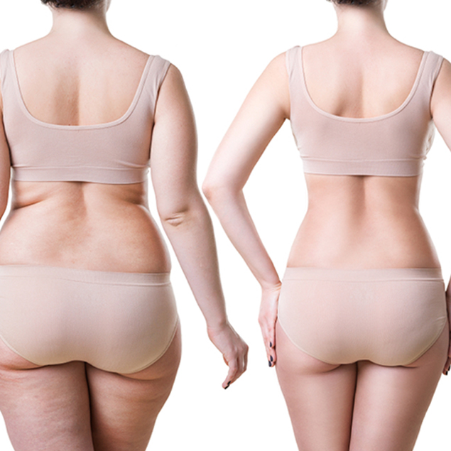 Liposuction - Fat Removal